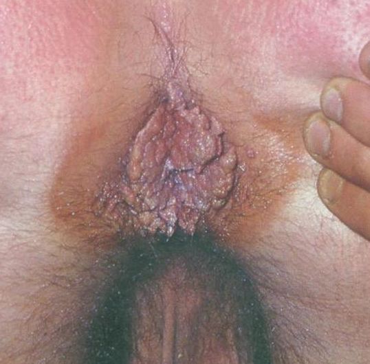 Internal Anal Warts - Do anal warts bleed - Other - XXX videos