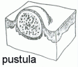 pustula